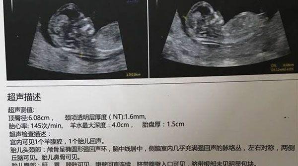 nt值越小越好并无依据，孩子聪明与否可不能这么判断