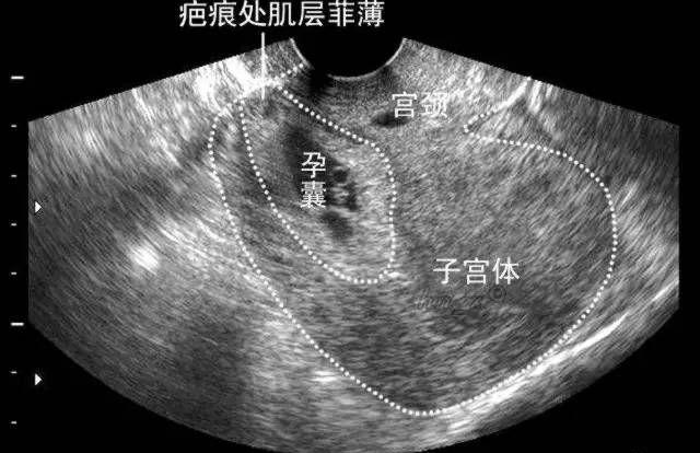 前次剖宫产，为什么做试管婴儿只给我移植1枚胚胎？