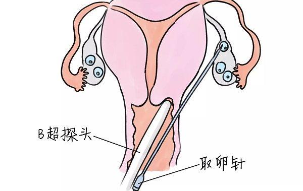 试管婴儿取卵后腹水怎么好得快？