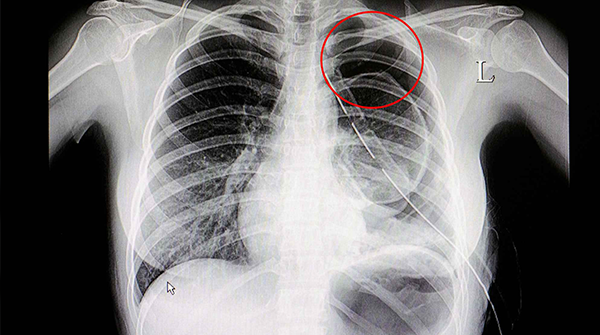 男女生做胸透检查方式都一样，按照检查步骤来准没错