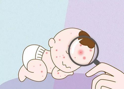 婴儿湿疹用什么药膏止痒最有效？