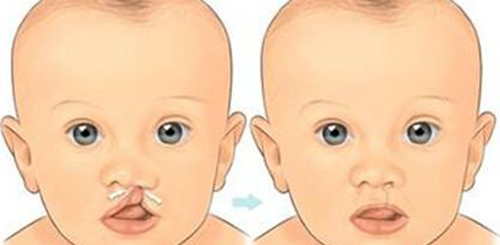 既安全又有效!兔唇大多采用这3种治疗手段