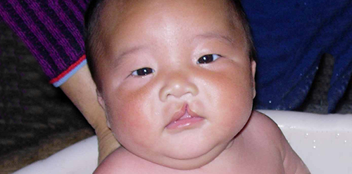 最低只需4000元!兔唇修复手术价格表明细