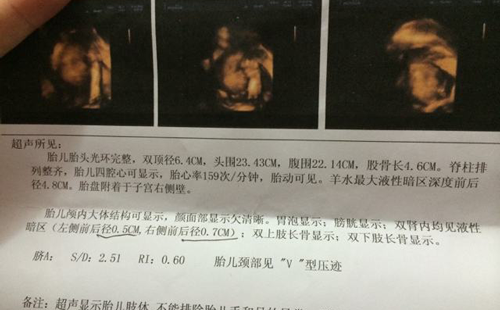 肾积水严重吗?关于肾积水的4大危害盘点