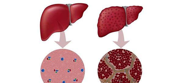 新生儿的脐带干细胞治疗肝硬化成功率高不高？