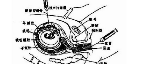 怀孕12周做绒毛穿刺，多久能拿到检查结果？