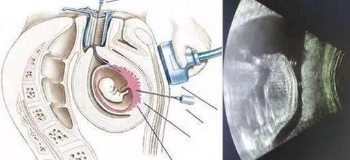 孕中期做绒毛穿刺不打麻药到底有多痛？