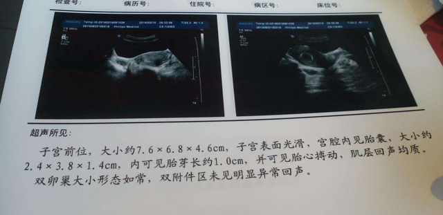 试管移植41天没有胎心胎芽？出现这些症状小心胎停育