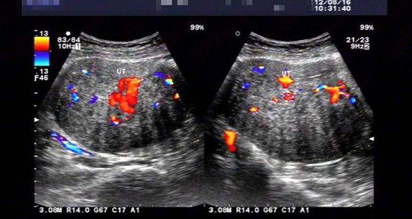 没有想的那么难!84年腺肌症做试管婴儿成功经验分享