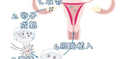 SCRC试管婴儿案例：圆三年不孕妈妈梦