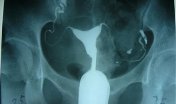 为什么都说输卵管造影不能轻易做？有什么危害吗？