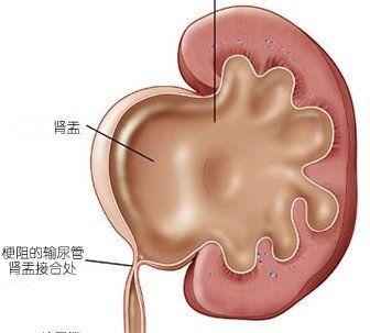 孕妇肾积水1.4cm算正常吗？
