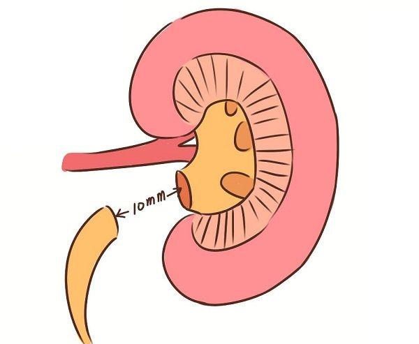 3个月的宝宝肾盂分离正常值应该是多少？