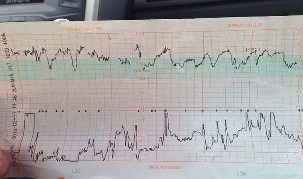 胎心监护看宫缩是有依据的，但看男女真没那么靠谱