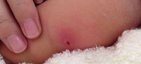 新生儿卡介苗接种失败的图片分享