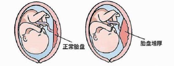 孕早期发生胎盘早剥怎么办？孩子还能保住吗？