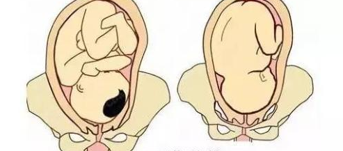 睡太多是导致出现胎位臀位的原因吗？