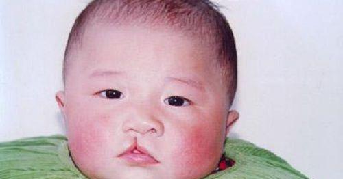 怀孕期间造成胎儿严重兔唇的原因是什么？