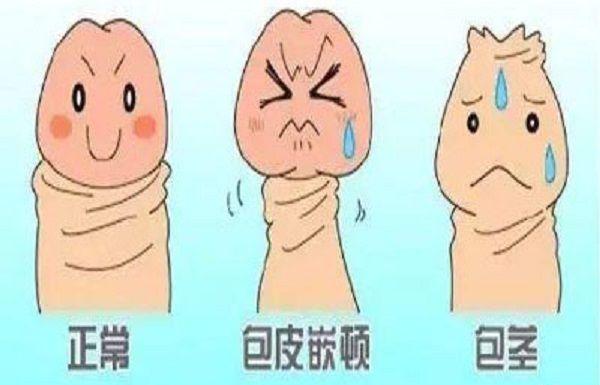 小儿包茎一定要割吗？应该挂什么科？