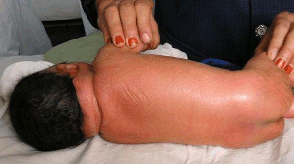 火棉胶婴儿的形成之谜，原来遗传因素才是罪魁祸首