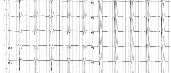 短QT间期综合征