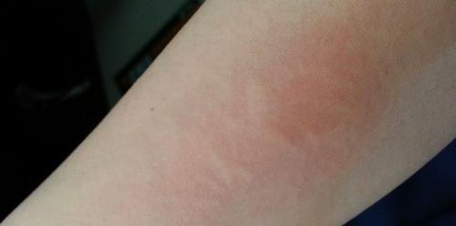 依诺肝素钠副作用：注射过量可能会导致过敏