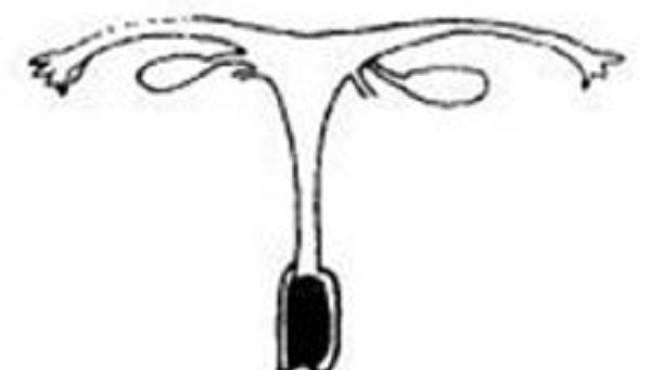 宫体厚度小于2cm是幼稚子宫的判断标准吗？