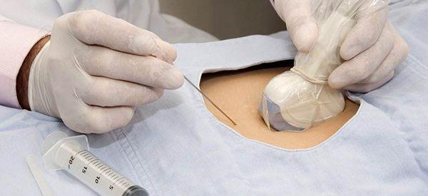 私立医院可以做2000块的羊水穿刺吗？