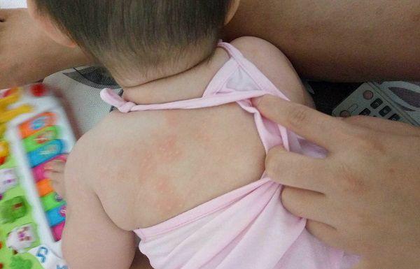 婴儿湿疹、热疹、痱子区别大，辨别起来很简单