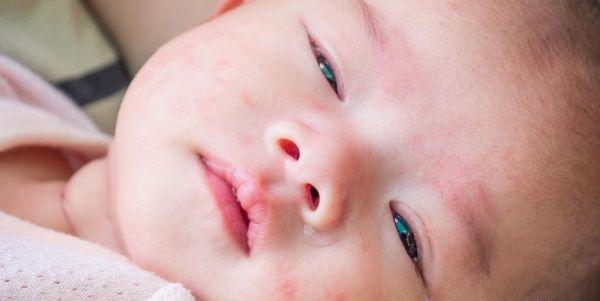 全身瘙痒、冒白尖，多图展示婴儿湿疹的3大症状表现