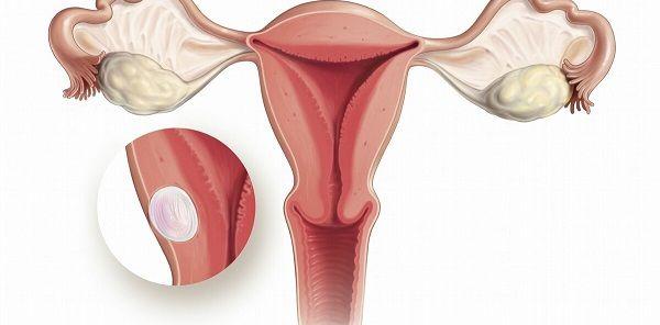 一文解读子宫腺肌症，临床常见类型汇总赶紧来看看