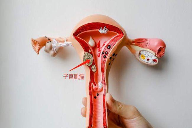 切除1/3子宫后的女人会怎么样，例假会不来吗？