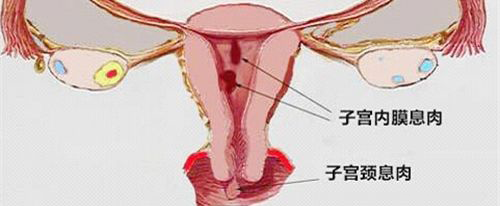 2cm子宫内膜息肉怀孕了，要不要切除？