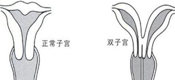 双角子宫一碰就怀孕是真的吗？