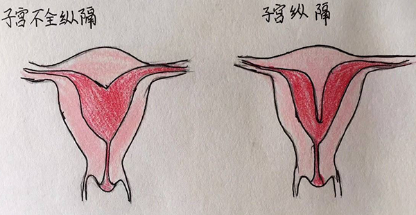 纵隔子宫是怎么引起的？十有八九是这些原因导致