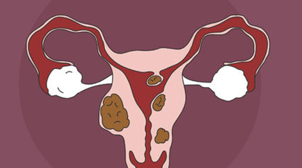 子宫肌瘤不用切除有克星，这一味中药泡水喝它最怕