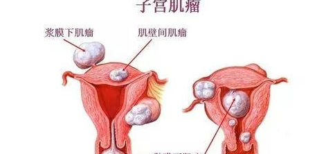 子宫肌瘤最佳治疗方法已找到，原来它最怕这4种食物