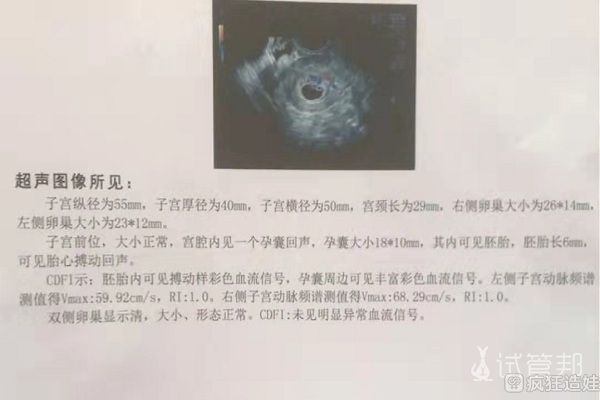 老公输精管缺如通过穿刺取精，二代试管婴儿移植验孕成功了