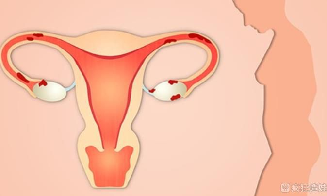 fsh水平高于90的卵巢闭经做第三代试管婴儿成功的案例多吗？