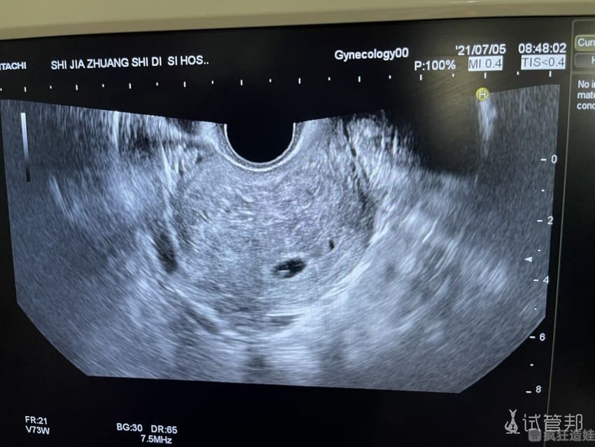 在台湾生基生殖医学中心第二代试管婴儿4周后流产 太伤心了