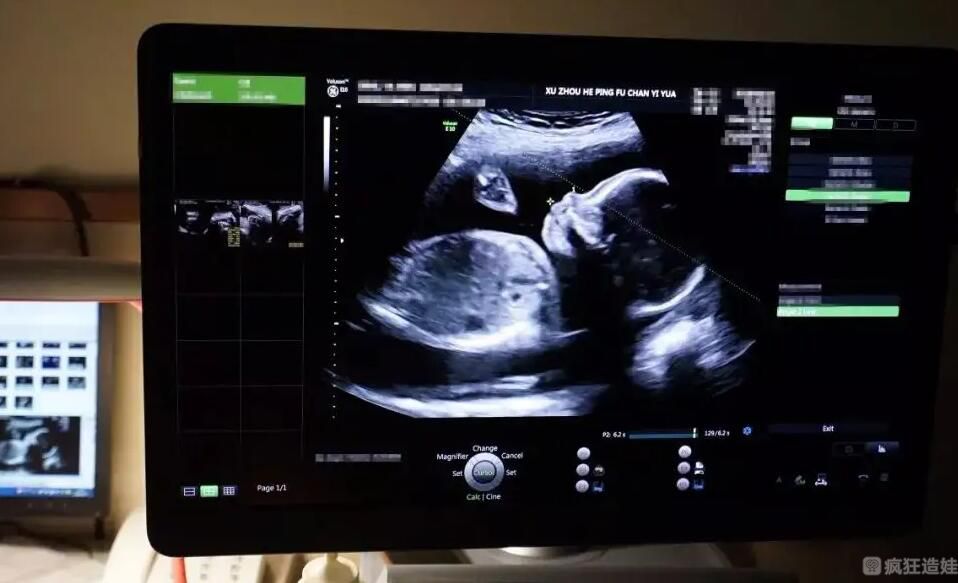 如何从彩超上面判断二代试管婴儿宝宝男女？彩超判断腹中宝宝性别方法