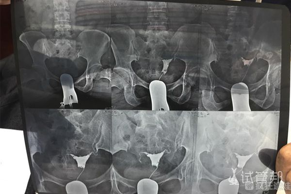 经历各种纠结，终于在长治和平医院第二代试管婴儿成功