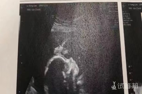在武汉大学人民医院做第三代试管婴儿经验总结