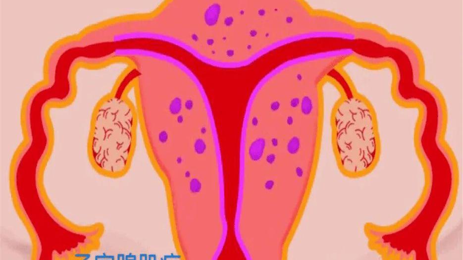 试管小知识：38岁严重腺肌症试管成功率有多高？也许没你想的高