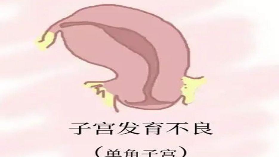先天性单角子宫能自然受孕吗？医生给出了具体答案