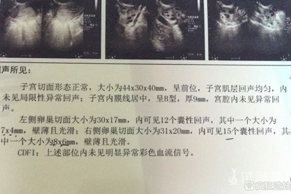 在浙江省人民医院第二代试管婴儿好孕，期待我家小宝贝