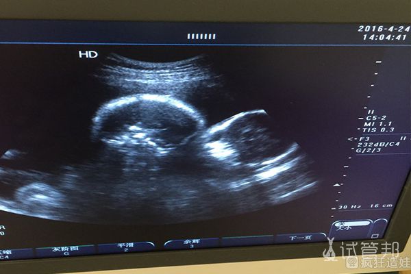 有在银川市第一人民医院做二代试管婴儿的姐妹吗？