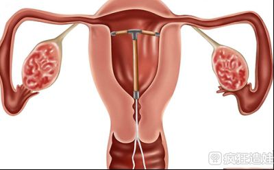 子宫畸形可以直接做第三代试管婴儿治疗吗？医生说，应该先治疗！