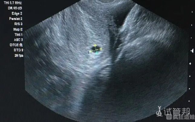 两次宫外孕走上第二代试管婴儿之路 在新加坡莱佛士医院的经历