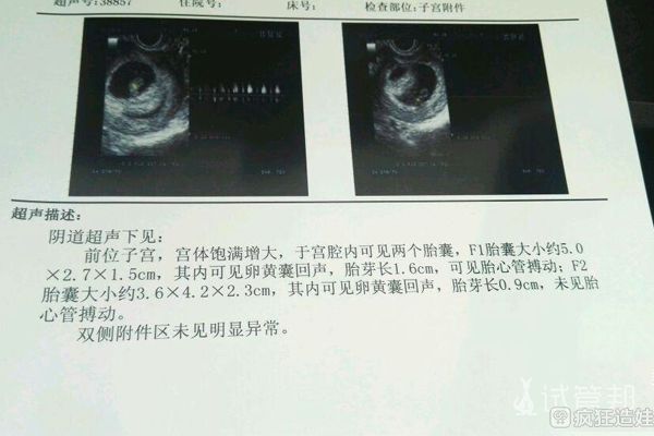 输卵管堵塞无奈选择第二代试管婴儿，顺利怀上双胞胎！